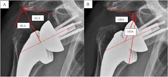 MDSA Meaning